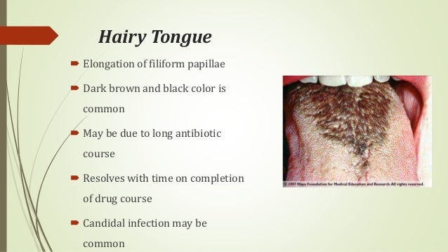 Hairy Tongue Disorder 9
